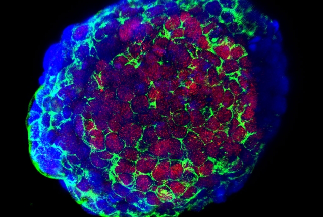 prostate cancer cells from patient biopsy