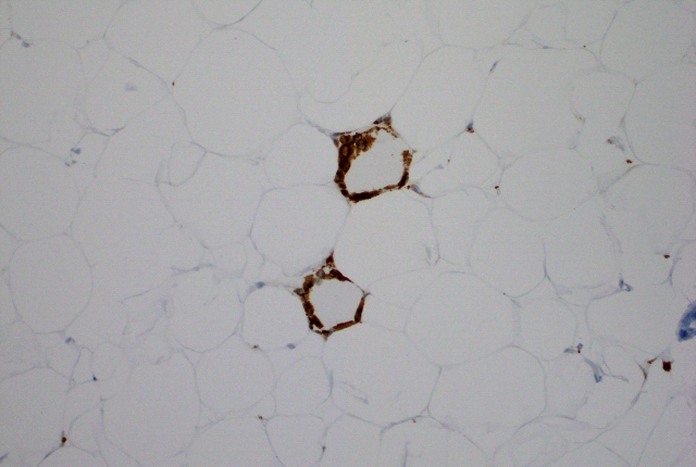 inflamed breast fat, brown colored immune cells surround the fat cells 