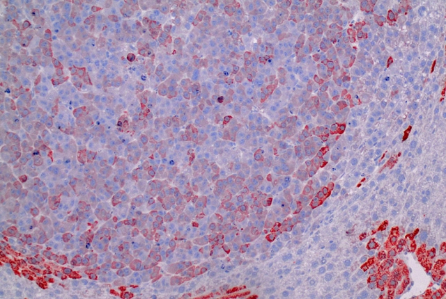 liver cancer cells, some stained red due to expression of mutant beta-catenin in tumors