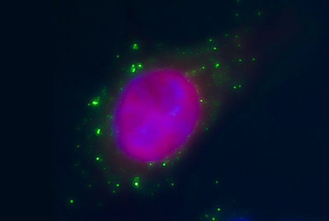 irradiated cancer cell with green flecks, DNA, in the cytoplasm