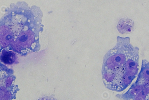 Leukemia cells