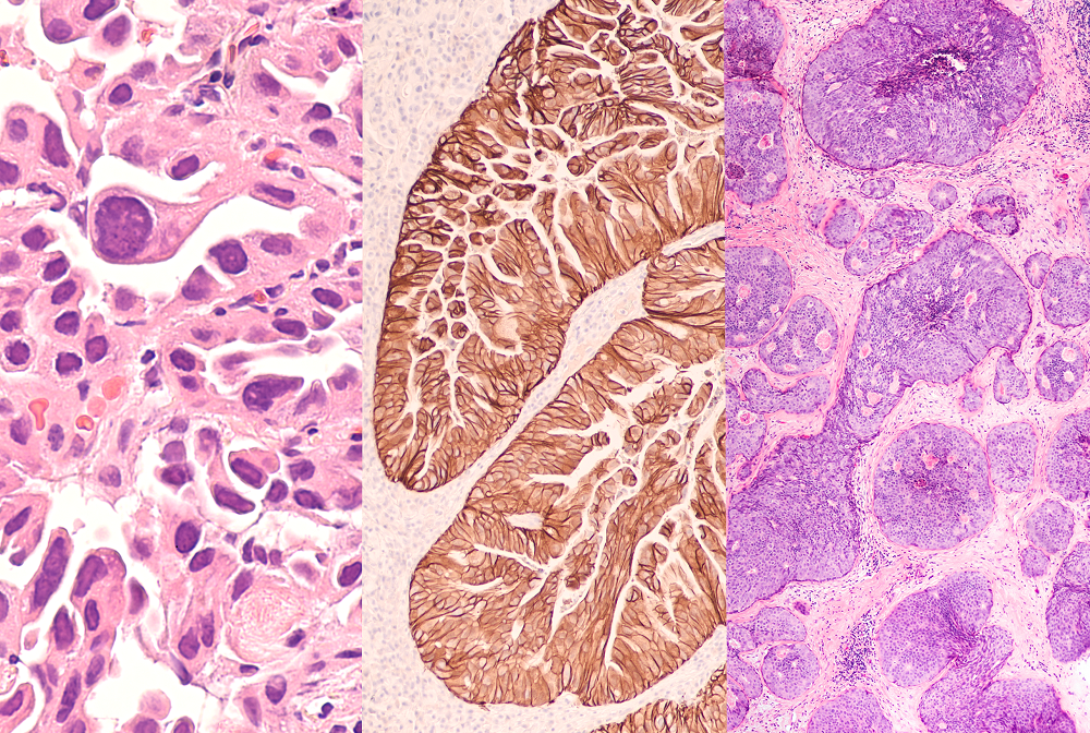 lung cancer, gastric cancer and breast cancer