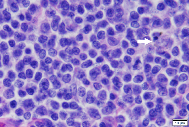 mantle cell lymphoma