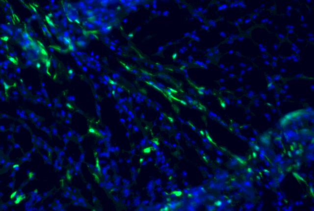 bone marrow derived immune cells, shown as green flecks against a blue background, travel to brain tumor in mice