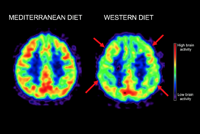 PET scans compare brain of a person on a Mediterranean-style diet and a person on a Western-style diet. The Mediterranean diet brain shows higher brain activity, especially in areas typically affected by Alzheimer's disease, denoted by arrows