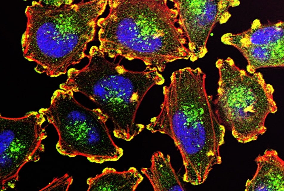 metastasizing melanoma cells