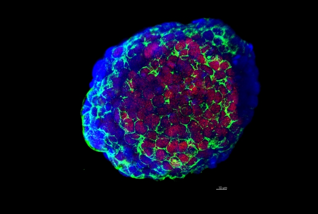neuroendocrine prostate cancer cells from patient biopsy shown in red, blue and fluorescent green 
