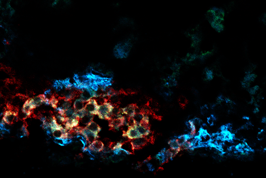 A transplanted pseudoislet made from CD63hi beta cells.