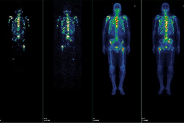 four imaging scans of skeletons: two on the left show where radiolabeled PSMA molecule targeted, highlighting the spine, ribcage and small areas near the center of the body. On the right, a radionuclide bone scan shows multiple metastatic lesions in the bone, brightest spots include the spine small areas near the center of the body.