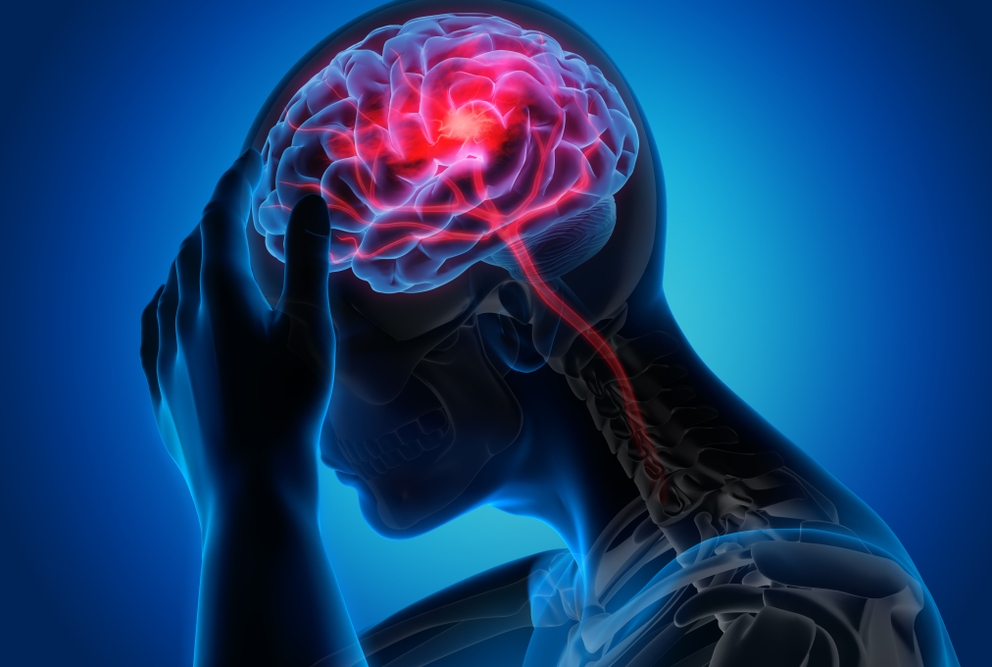 an illustration of someone having headache pain due to stroke complications