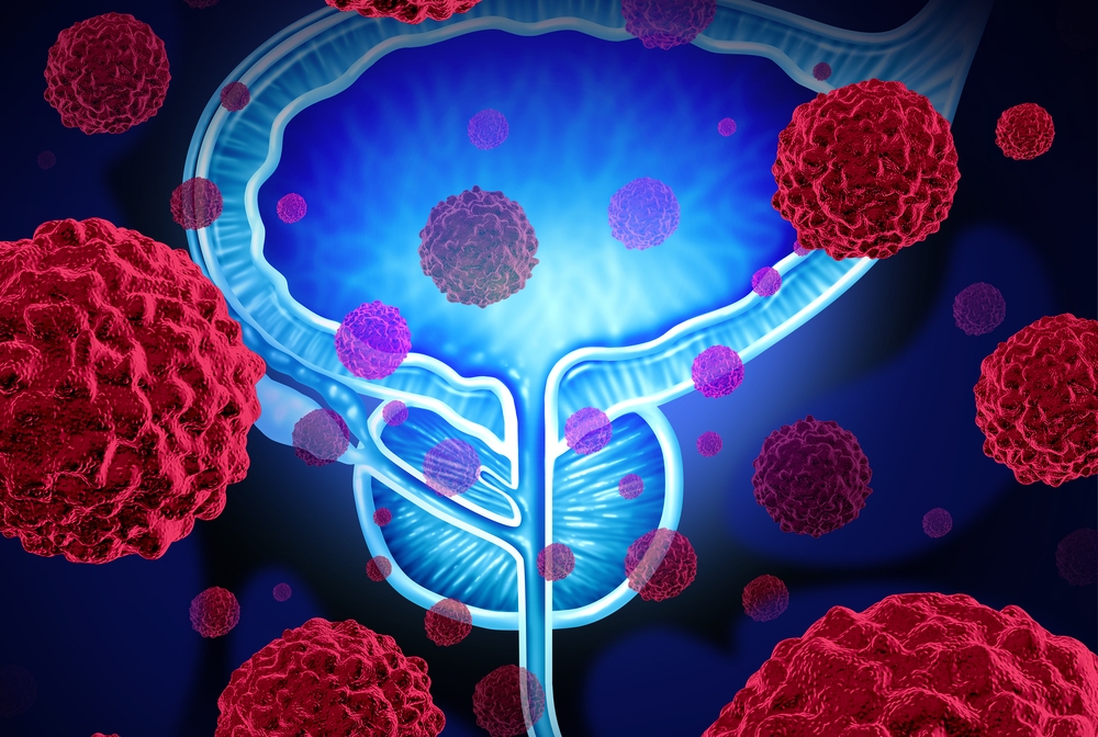 illustration of prostate cancer cells