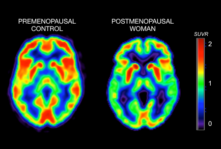 Brain scans comparing a premenopausal brain with a postmenopausal brain. The premenopausal brain has brighter colors showing higher brain activity than the postmenopausal brain. 