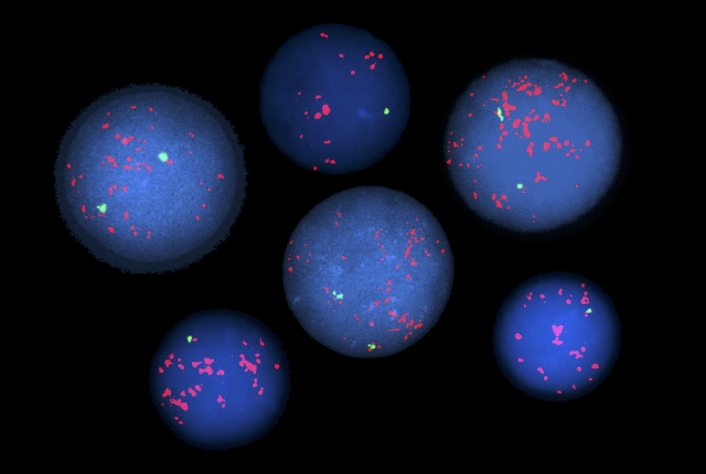 fluorescent chromosome staining shows genetic abnormalities in blood cells
