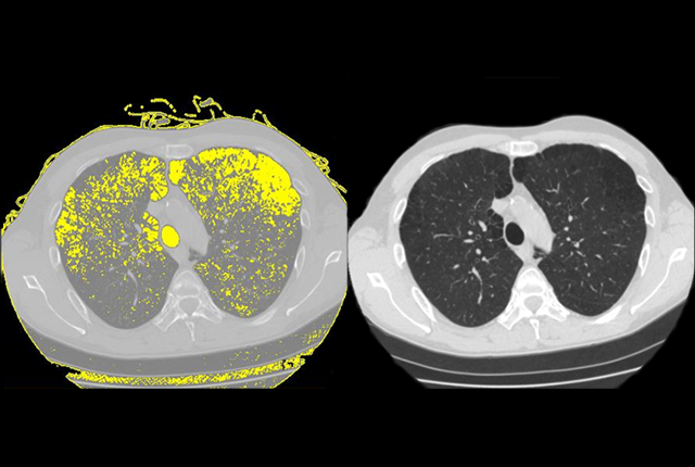 Chest CT scan of a lung from an HIV positive man with emphysema. On the right is the normal scan, on the left, many areas of emphysema are highlighted in yellow 