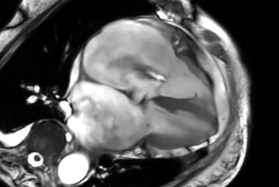 black and white cardiac mri image