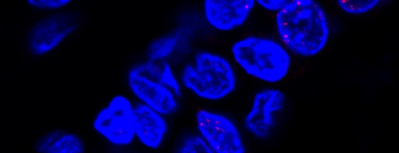 Damage to DNA (red) in nuclei (blue) of normal cells in the milk ducts of a BRCA mutation carrier was identified using immunofluorescence labeling of breast tissue in women with higher BMI. Credit: Dr. Priya Bhardwaj 