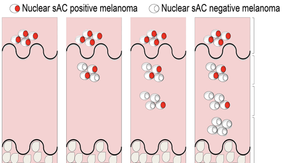 diagram of loss of nuclear soluble adenylyl cyclase in melanoma cells