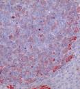 liver cancer cells, some stained red due to expression of mutant beta-catenin in tumors
