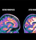 PET scan brain images showing estrogen receptor density