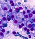 multiple myeloma cells