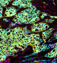 human early-stage non-small cell lung cancer, tumor cells are cyan, surrounded by yellow, PD-L1, a few red spots are seen around the edges, which are T cells expressing PD-1, blue 