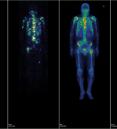 four imaging scans of skeletons: two on the left show where radiolabeled PSMA molecule targeted, highlighting the spine, ribcage and small areas near the center of the body. On the right, a radionuclide bone scan shows multiple metastatic lesions in the bone, brightest spots include the spine small areas near the center of the body.