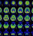 PET scan brain images