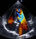 image of transthoracic two-dimensional color Doppler echocardiography
