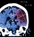 brain scan of a stroke patient