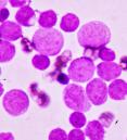 Blood smear under microscopy showing adult acute myeloid leukemia.