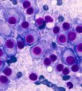 bone marrow cancer of malignant plasma cells