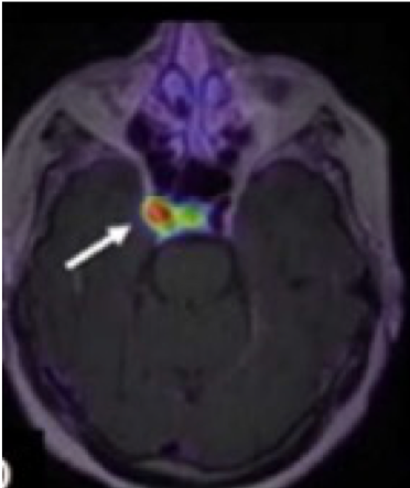 Brian x-ray with a white arrow at the top.