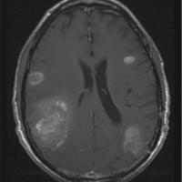 Event Image for Brain Metastasis Tumor Board 